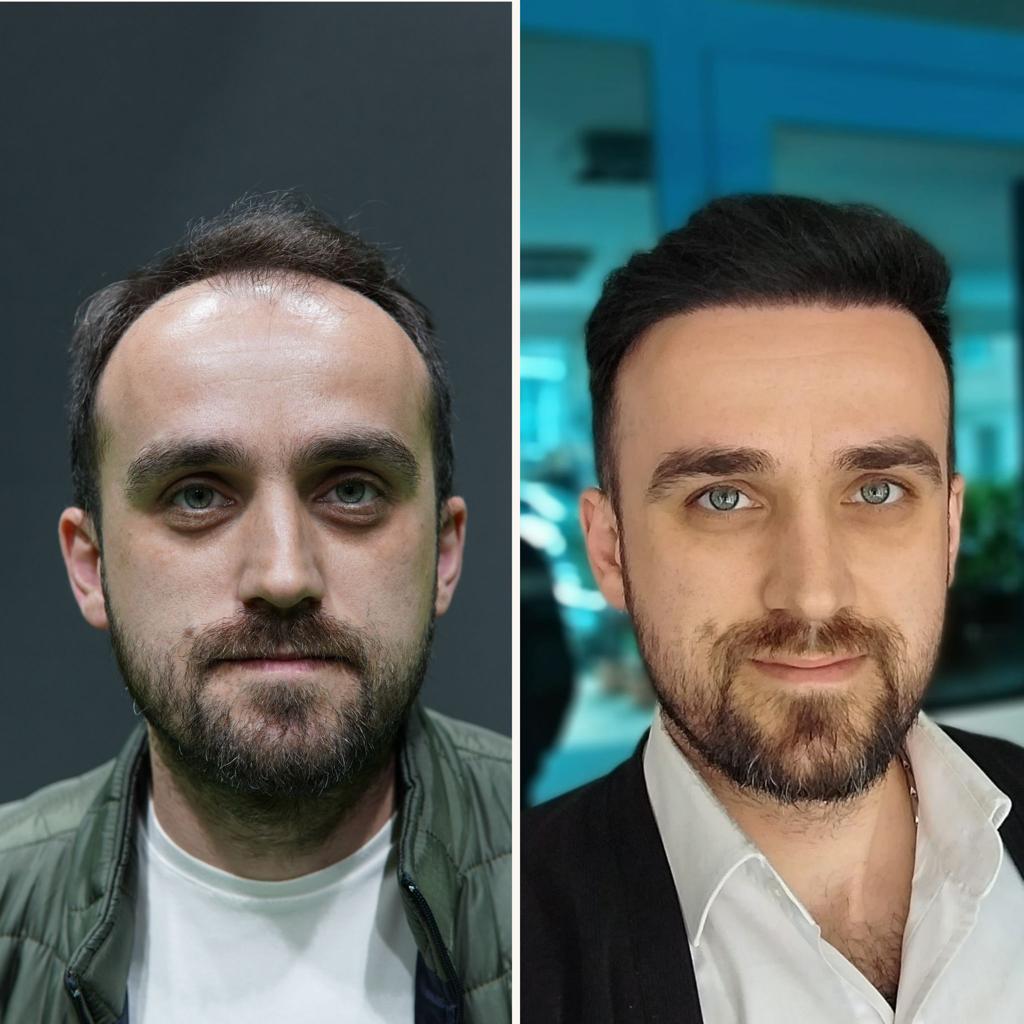 prima e dopo trapianto capelli 9